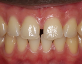 Before - Platinum Orthodontics Dental