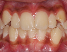 Before - Platinum Orthodontics Dental