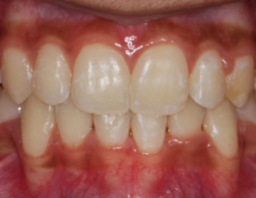After - Platinum Orthodontics Dental
