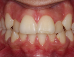 Before - Platinum Orthodontics Dental