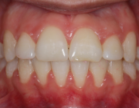 After - Platinum Orthodontics Dental