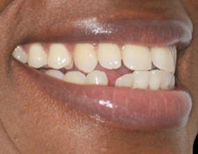 Before - Platinum Orthodontics Dental