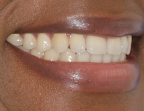 After - Platinum Orthodontics Dental