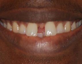 Before - Platinum Orthodontics Dental