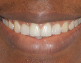 After - Platinum Orthodontics Dental