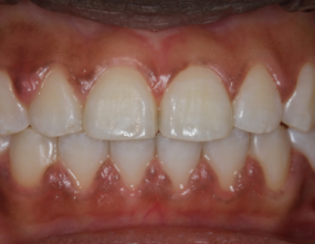 After - Platinum Orthodontics Dental