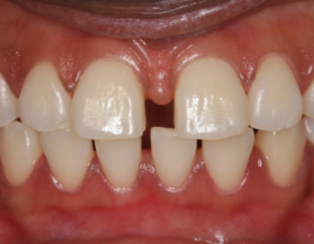 Before - Platinum Orthodontics Dental