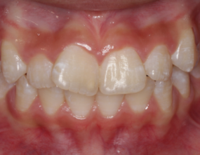 Before - Platinum Orthodontics Dental