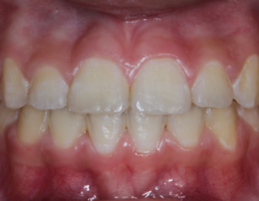 After - Platinum Orthodontics Dental