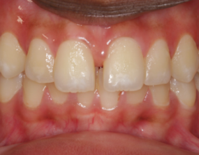 Before - Platinum Orthodontics Dental