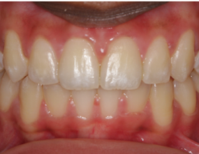 After - Platinum Orthodontics Dental