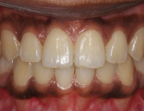 After - Platinum Orthodontics Dental