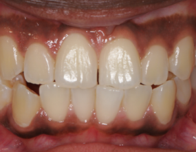 Before - Platinum Orthodontics Dental