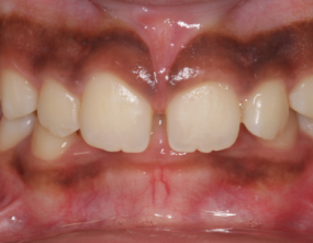 Before - Platinum Orthodontics Dental