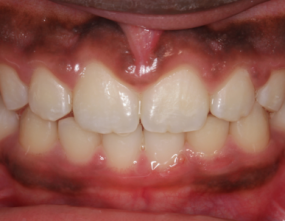 After - Platinum Orthodontics Dental